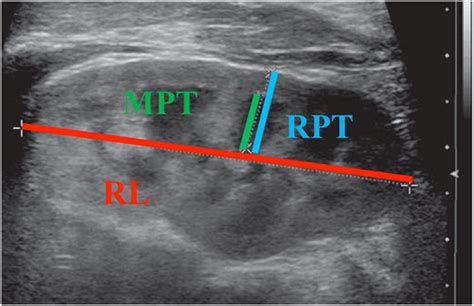 renal ultrasound parenchymal thickness